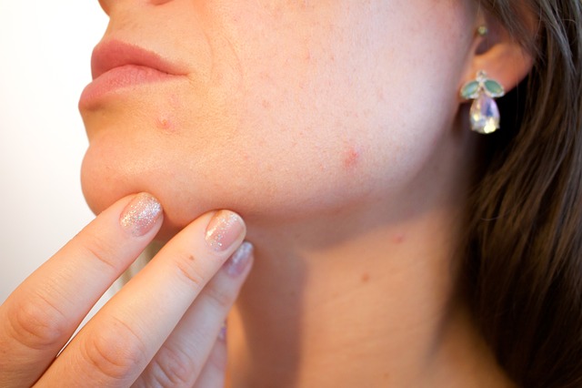 Acne con 25: come curare la pelle del vostro problema