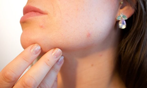 Niente più brufoli: si può fare questo con l’acne adulto